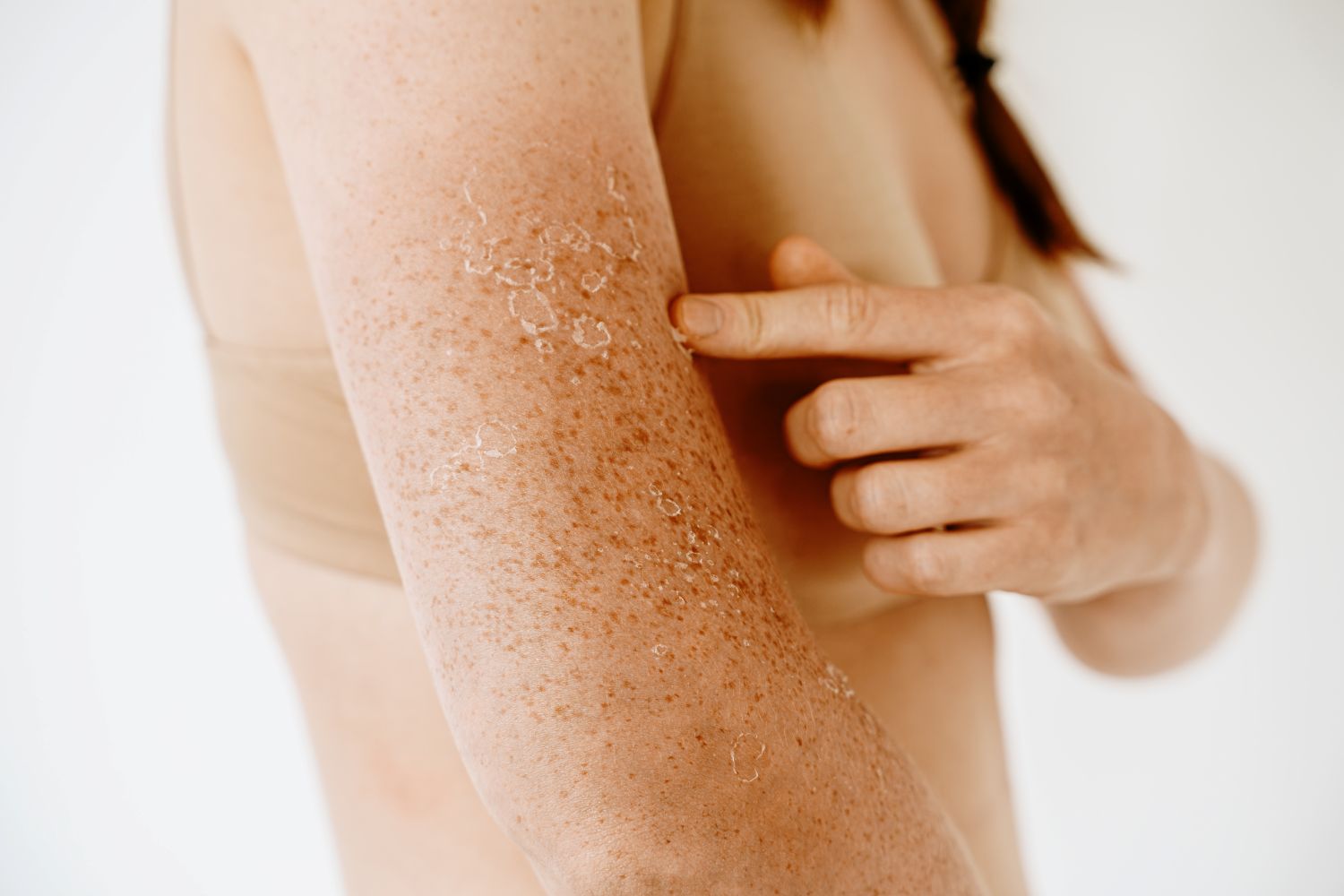 Dry skin