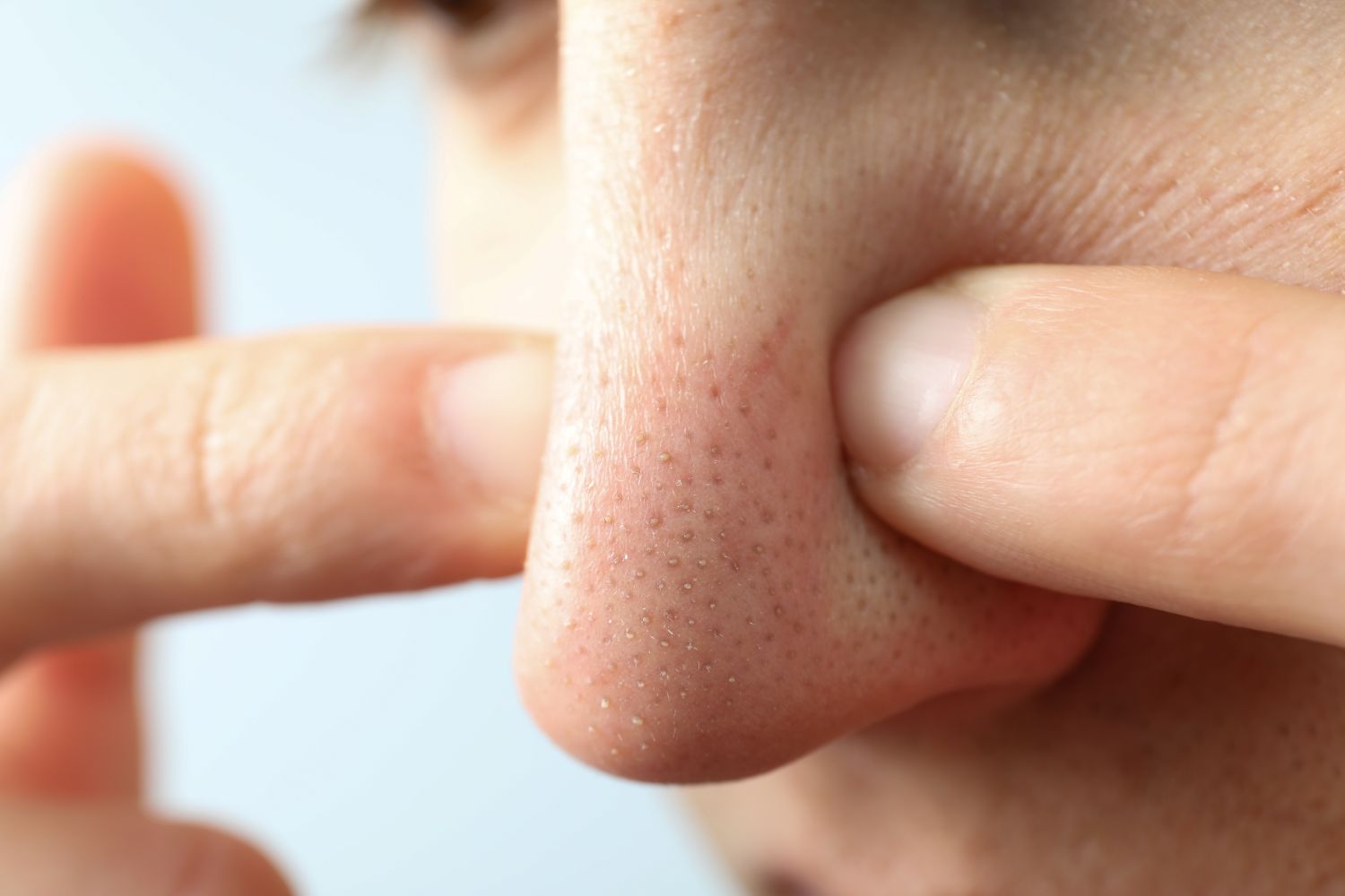 Enlarged pores can be treated.